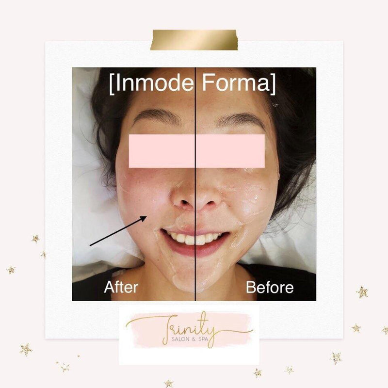 INMODE Forma Treatment • 인모드포마 Spa Trinity 